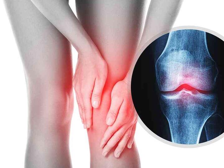 Jak se zbavit artrózy