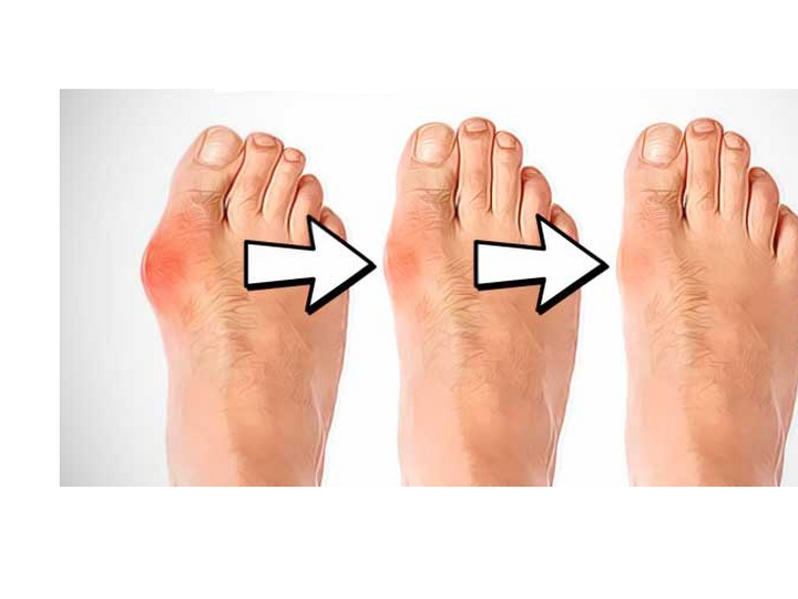 Onemocnění hallux valgus – vbočený palec